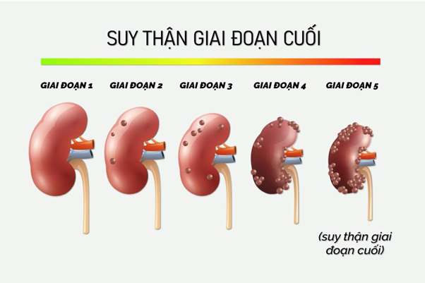 7 th&oacute;i quen đơn giản gi&uacute;p giảm nguy cơ suy thận người Việt n&ecirc;n l&agrave;m - Ảnh 2.