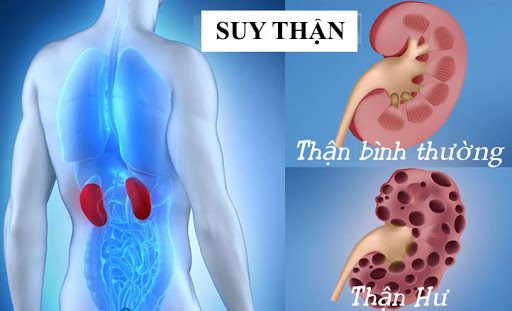 7 th&oacute;i quen đơn giản gi&uacute;p giảm nguy cơ suy thận người Việt n&ecirc;n l&agrave;m - Ảnh 1.