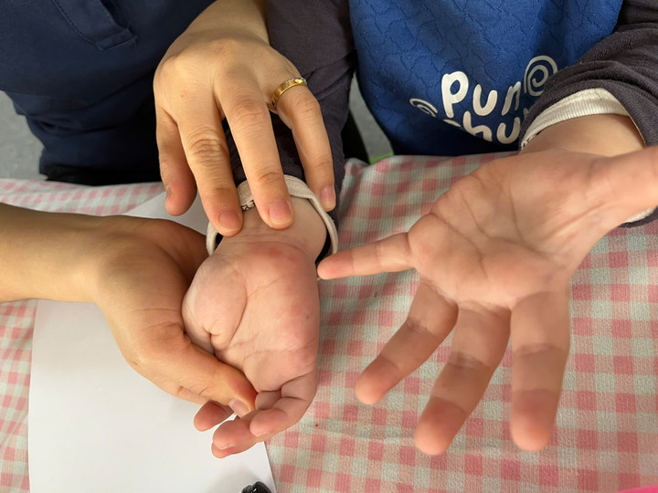 Tưởng con sốt ph&aacute;t ban, b&agrave; mẹ t&aacute; hỏa khi b&aacute;c sĩ kết luận tay ch&acirc;n miệng - Ảnh 1.