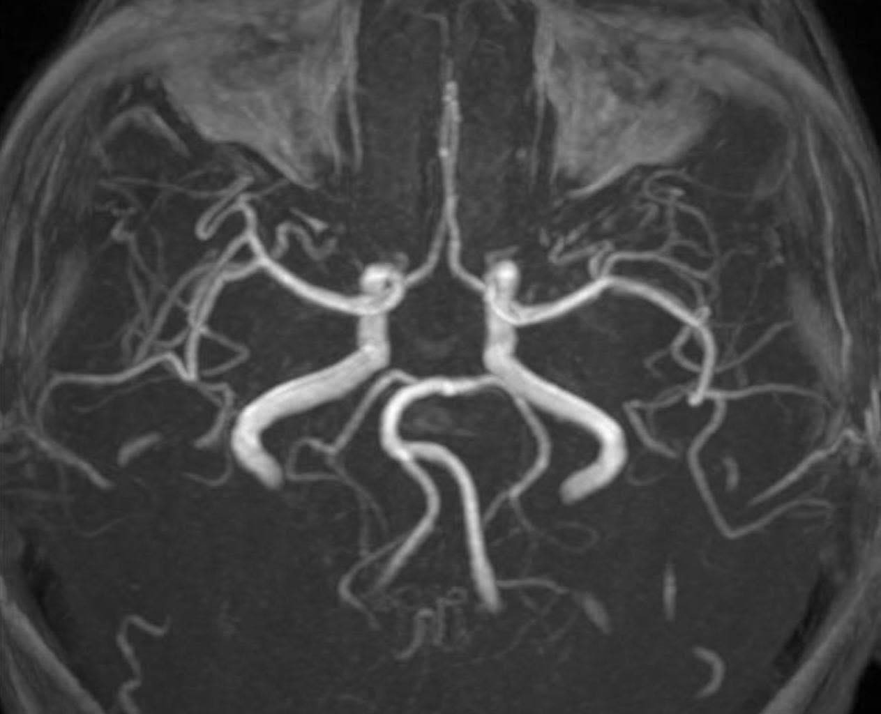 Nữ bệnh nh&acirc;n đột quỵ b&aacute;c sĩ chỉ ra nguy&ecirc;n nh&acirc;n bất ngờ - Ảnh 2.
