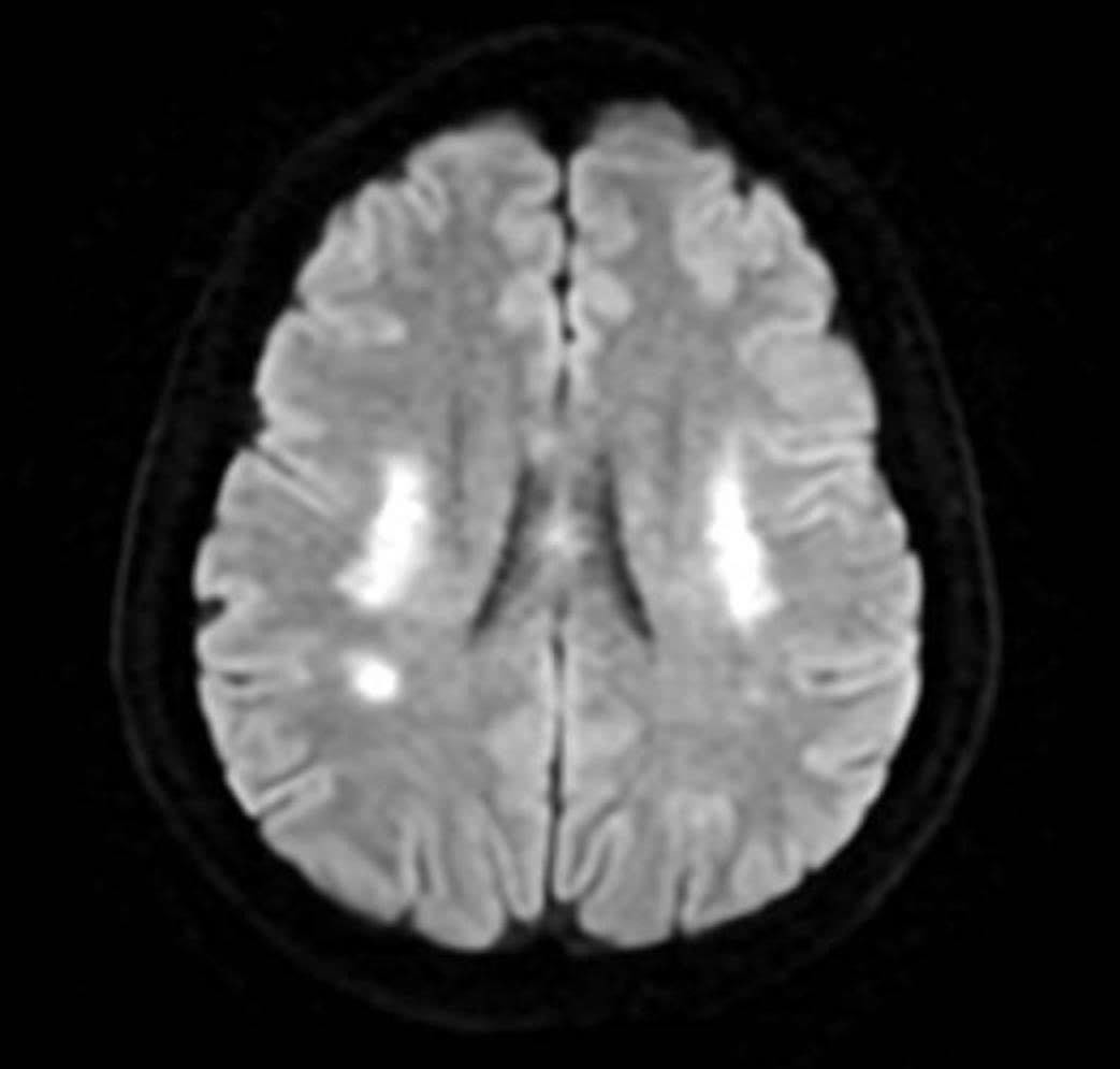 Nữ bệnh nh&acirc;n đột quỵ b&aacute;c sĩ chỉ ra nguy&ecirc;n nh&acirc;n bất ngờ - Ảnh 1.