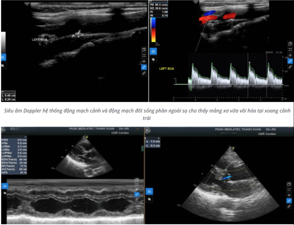 Người phụ nữ đột quỵ lúc nửa đêm có biểu hiện trước 10 ngày, nhưng dấu hiệu này người Việt rất dễ bỏ qua - Ảnh 1.