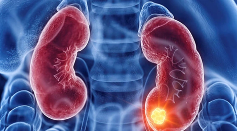 Người đàn ông 43 tuổi phát hiện ung thư thận, thừa nhận một sai lầm nhiều người Việt mắc phải - Ảnh 1.