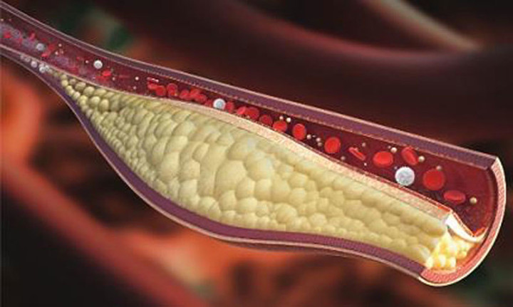 M&aacute;u nhiễm mỡ nguy hiểm thế n&agrave;o? - Ảnh 1.