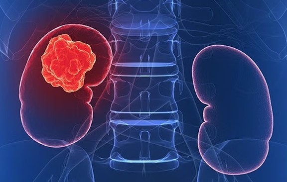 Từ vụ bé 8 tuổi qua đời vì ung thư thận: 5 thói quen ăn uống tàn phá thận, người Việt nhất định phải tránh - Ảnh 1.