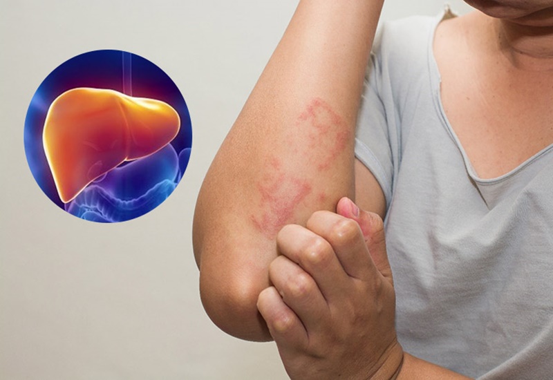 ສັນຍານເຕືອນວ່າຕັບຂອງເຈົ້າໜັກເກີນ, ເຈົ້າຕ້ອງລ້າງພິດຕັບໃຫ້ໄວເທົ່າທີ່ຈະໄວໄດ້ - ຮູບ 3. Dấu hiệu cảnh báo gan của bạn đang quá tải, cần thải độc gan càng sớm càng tốt - Ảnh 3.