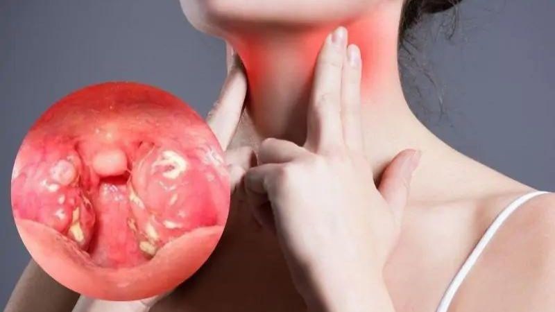 Biến chứng đáng sợ của viêm họng khi trời lạnh, dấu hiệu cần gặp bác sĩ gấp - Ảnh 2.