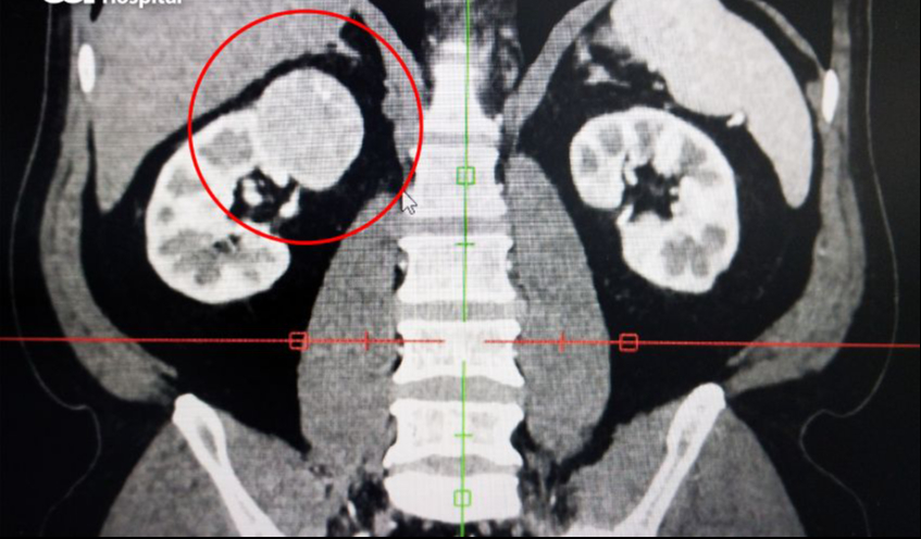 Người đàn ông 62 tuổi ở TP.HCM phát hiện ung thư thận sớm nhờ làm một việc mà rất nhiều người Việt bỏ qua- Ảnh 2. Người đàn ông 62 tuổi ở TP.HCM phát hiện ung thư thận sớm nhờ làm một việc mà rất nhiều người Việt bỏ qua- Ảnh 2.