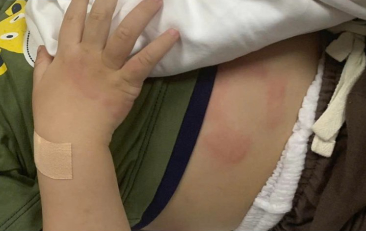 Mẹ thiếu sữa, bé 7 tháng tuổi bị sốc phản vệ liên tiếp sau 2 lần uống sữa công thức- Ảnh 2.