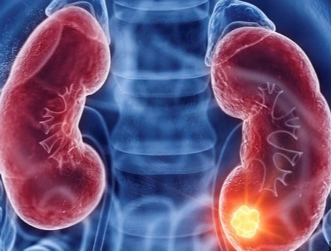 Người đàn ông 62 tuổi ở TP.HCM phát hiện ung thư thận sớm nhờ làm một việc mà rất nhiều người Việt bỏ qua- Ảnh 3. Người đàn ông 62 tuổi ở TP.HCM phát hiện ung thư thận sớm nhờ làm một việc mà rất nhiều người Việt bỏ qua- Ảnh 3.