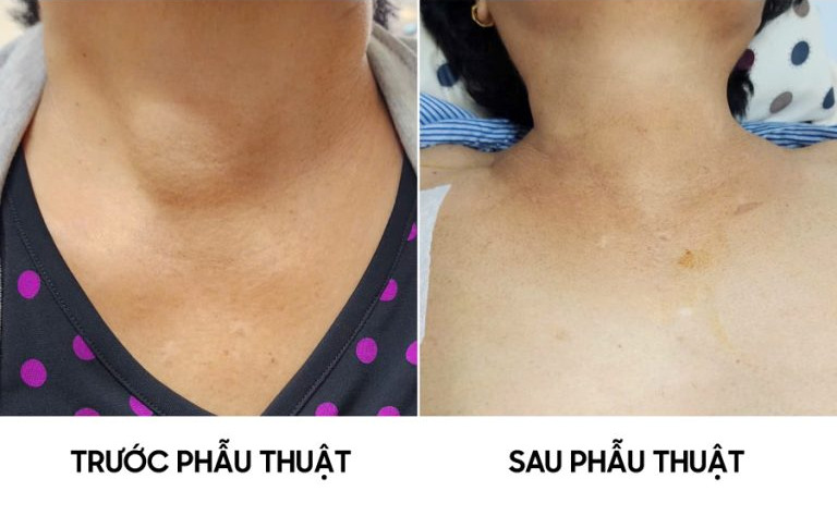 אישה בת 59 גילתה גידול בבלוטת התריס מסימן שרבים מהווייטנאמים מתעלמים ממנו - תמונה 3. Người phụ nữ 59 tuổi phát hiệu u tuyến giáp từ dấu hiệu nhiều người Việt bỏ qua- Ảnh 3.