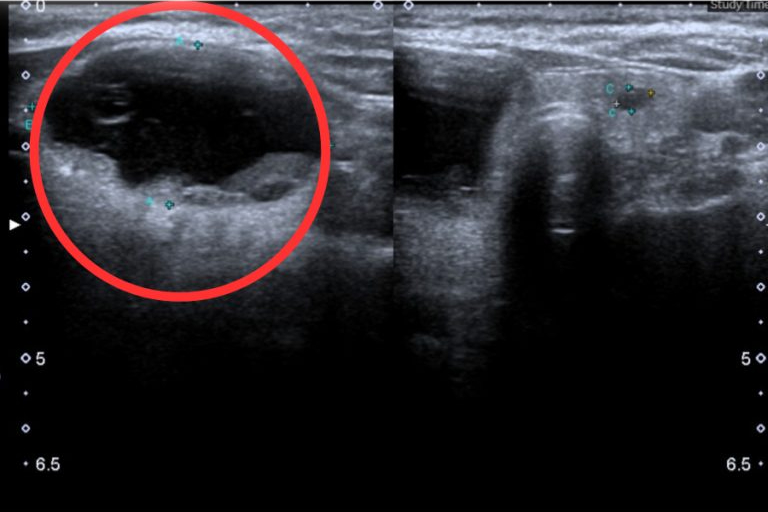 אישה בת 59 גילתה גידול בבלוטת התריס מסימן שרבים מהווייטנאמים מתעלמים ממנו - תמונה 2. Người phụ nữ 59 tuổi phát hiệu u tuyến giáp từ dấu hiệu nhiều người Việt bỏ qua- Ảnh 2.