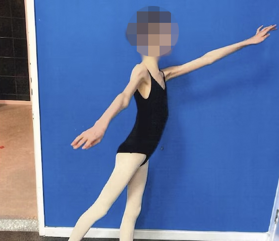 unnamed-ballerina-victim-malnourishment-parents-98662234-17397844515871972363626-1739838234413-1739838234510198526325.jpg