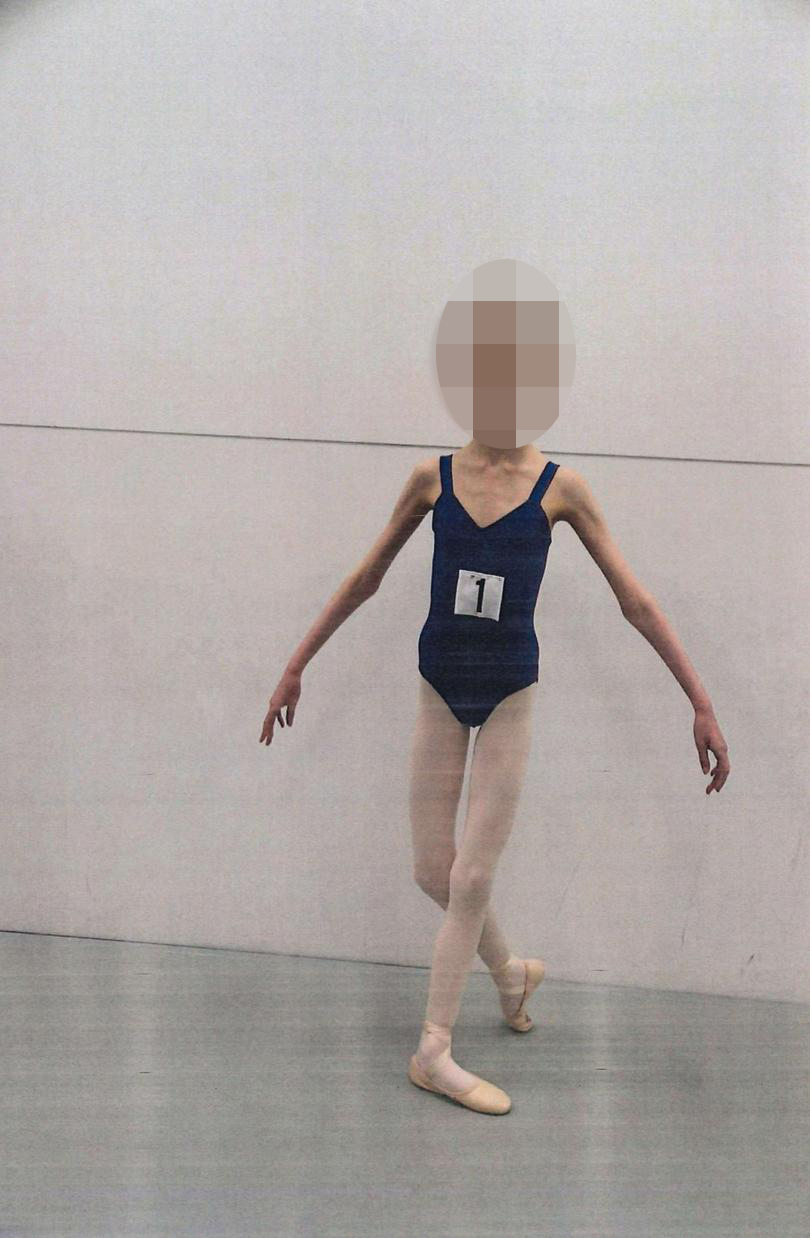 unnamed-ballerina-victim-malnourishment-parents-98662364-17397844861251799507139-1739838235606-1739838235668174891274.jpg