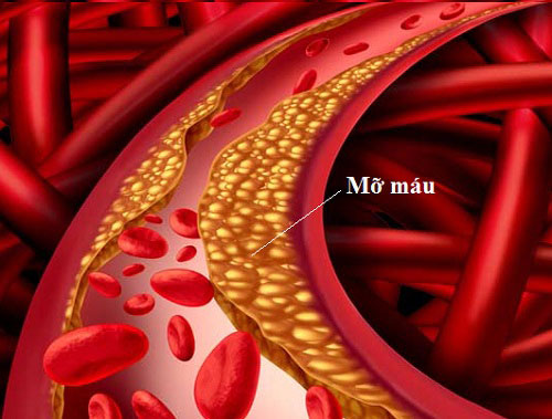 Cảnh giác với rối loạn mỡ máu sau Tết, U50 nhất định phải biết điều này- Ảnh 2. Cảnh giác với rối loạn mỡ máu sau Tết, U50 nhất định phải biết điều này- Ảnh 2.