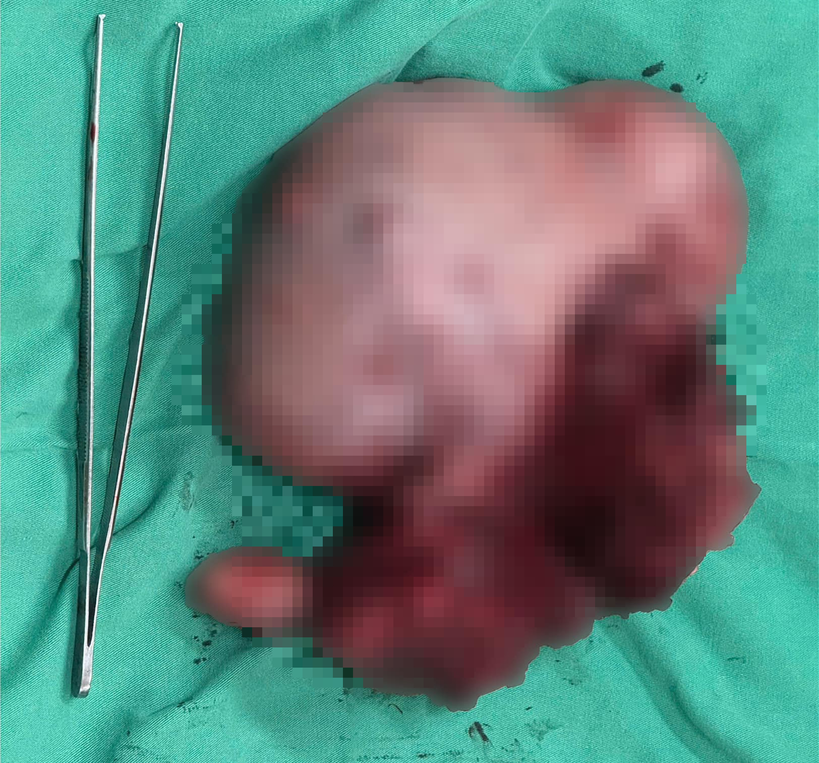 Người phụ nữ 43 tuổi vừa mang thai con nặng 4kg vừa có khối u xơ tử cung gần 3kg - Ảnh 2.