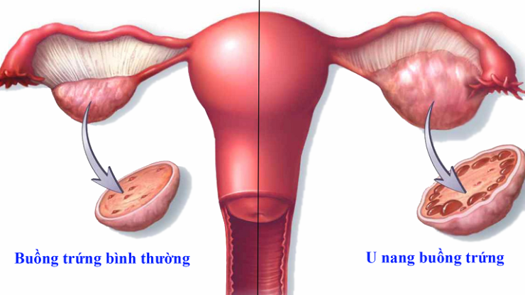 U nang buồng trứng: từ nguyên nhân, triệu chứng đến chẩn đoán và điều trị -  Bệnh viện quận 11