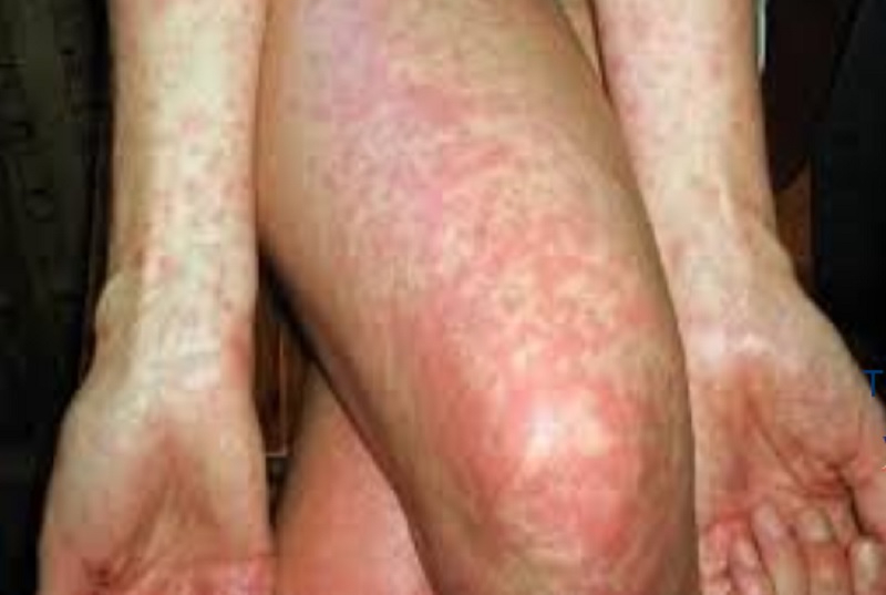 Bé gái sốt cao, nổi ban toàn thân từ căn bệnh hay gặp mùa đông xuân, bác sĩ khuyến cáo cách phòng ngừa- Ảnh 1.