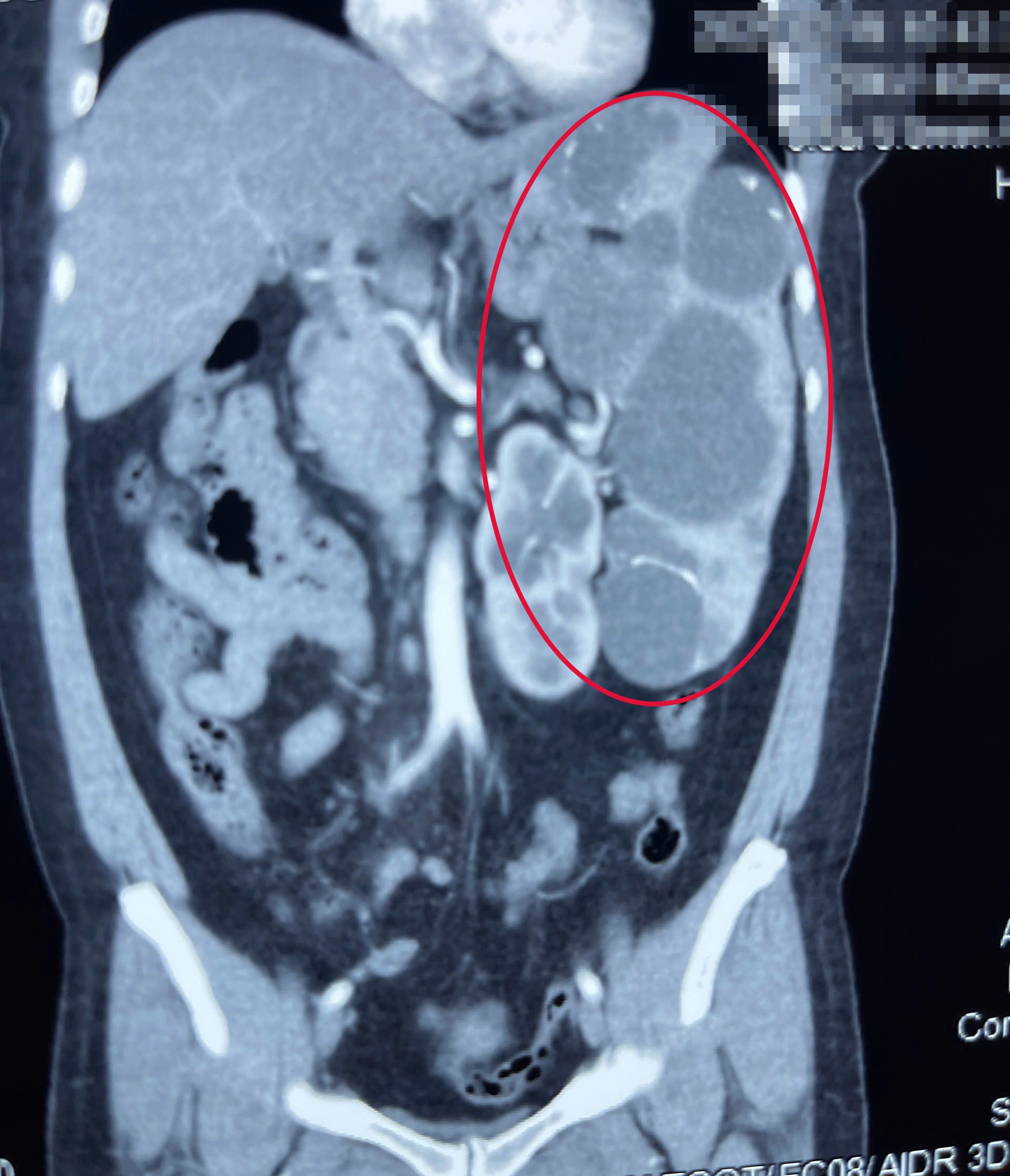 Una mujer de 53 años acudió al médico con dolor en el hipocondrio izquierdo y se sorprendió al descubrir un quiste esplénico  Đau tức vùng hạ sườn trái, người phụ nữ 53 tuổi đi khám bất ngờ phát hiện u nang lách 'khủng'- Ảnh 2.