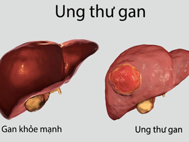 Đi khám vì mệt mỏi, đau tức ngực, người đàn ông 60 tuổi bất ngờ phát hiện ung thư gan- Ảnh 2.