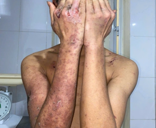 Toàn thân tổn thương, chảy dịch vùng sinh dục do đắp kiến ba khoang chữa ngứa - Ảnh 1.