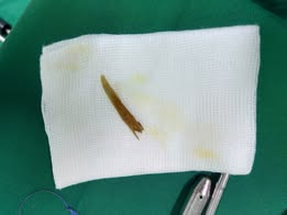 Nuốt phải xương gà, nhiều người bị thủng ruột non- Ảnh 2.