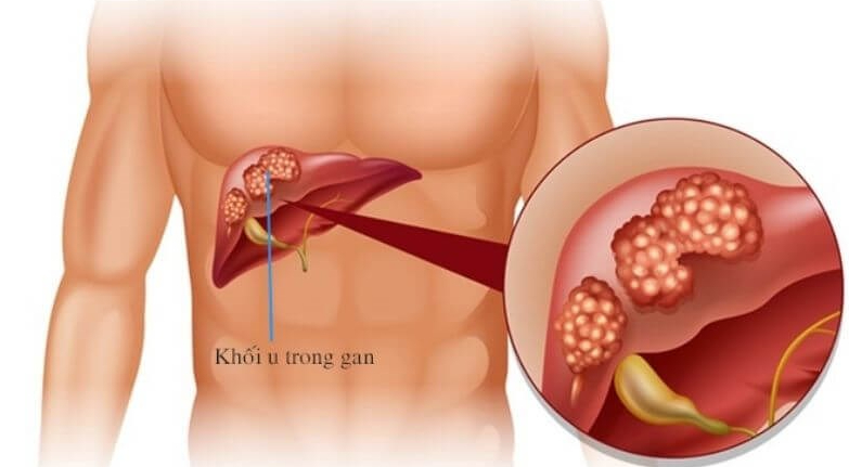 Lên mạng tìm thầy chữa ung thư gan, người đàn ông 37 tuổi ở Hà Nội qua đời trong sự ngỡ ngàng của người thân - Ảnh 3.