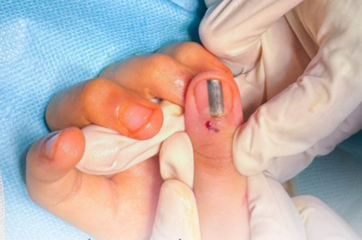 Xuất hiện vệt đen trong móng tay nghi ung thư da, bé 10 tuổi đi khám bất ngờ nhận tin vui - Ảnh 2.