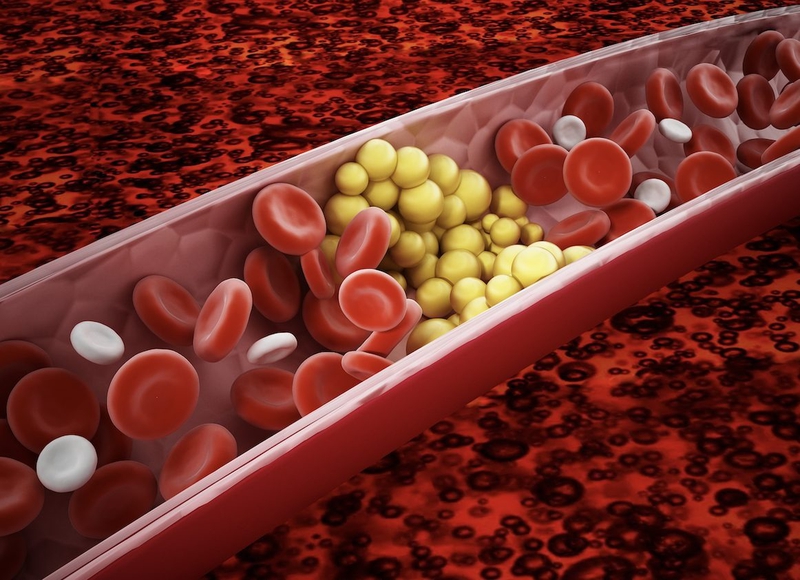 6 biến chứng đáng sợ của bệnh rối loạn mỡ máu - Ảnh 2.