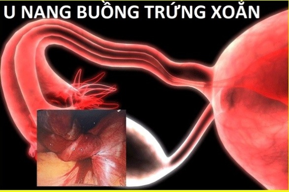 u-nang-buong-trung-xoan5-1741428459398939628309.jpg