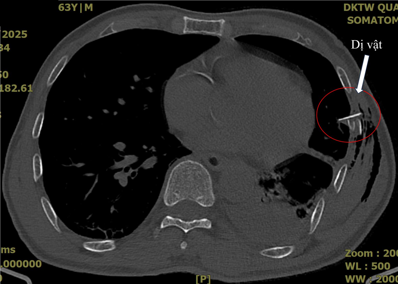 Người đàn ông bị xương sườn đâm thủng phổi- Ảnh 2.