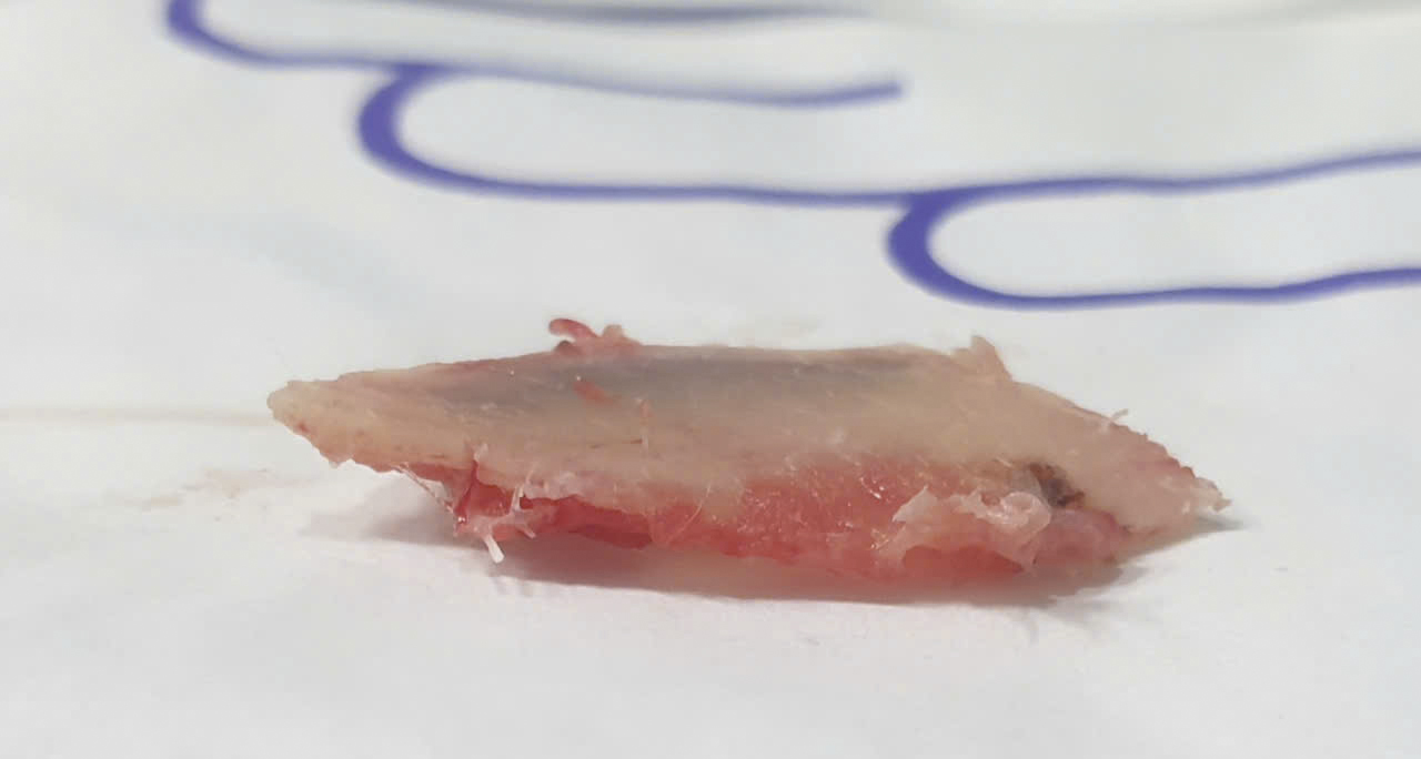 Người đàn ông bị xương sườn đâm thủng phổi- Ảnh 3.