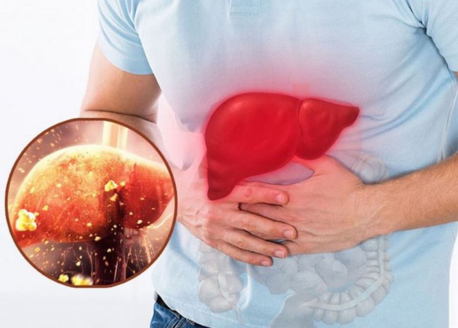 Người đàn ông có chỉ số men gan cao gấp 38 lần thừa nhận một sai lầm mà nhiều người Việt mắc phải- Ảnh 2.