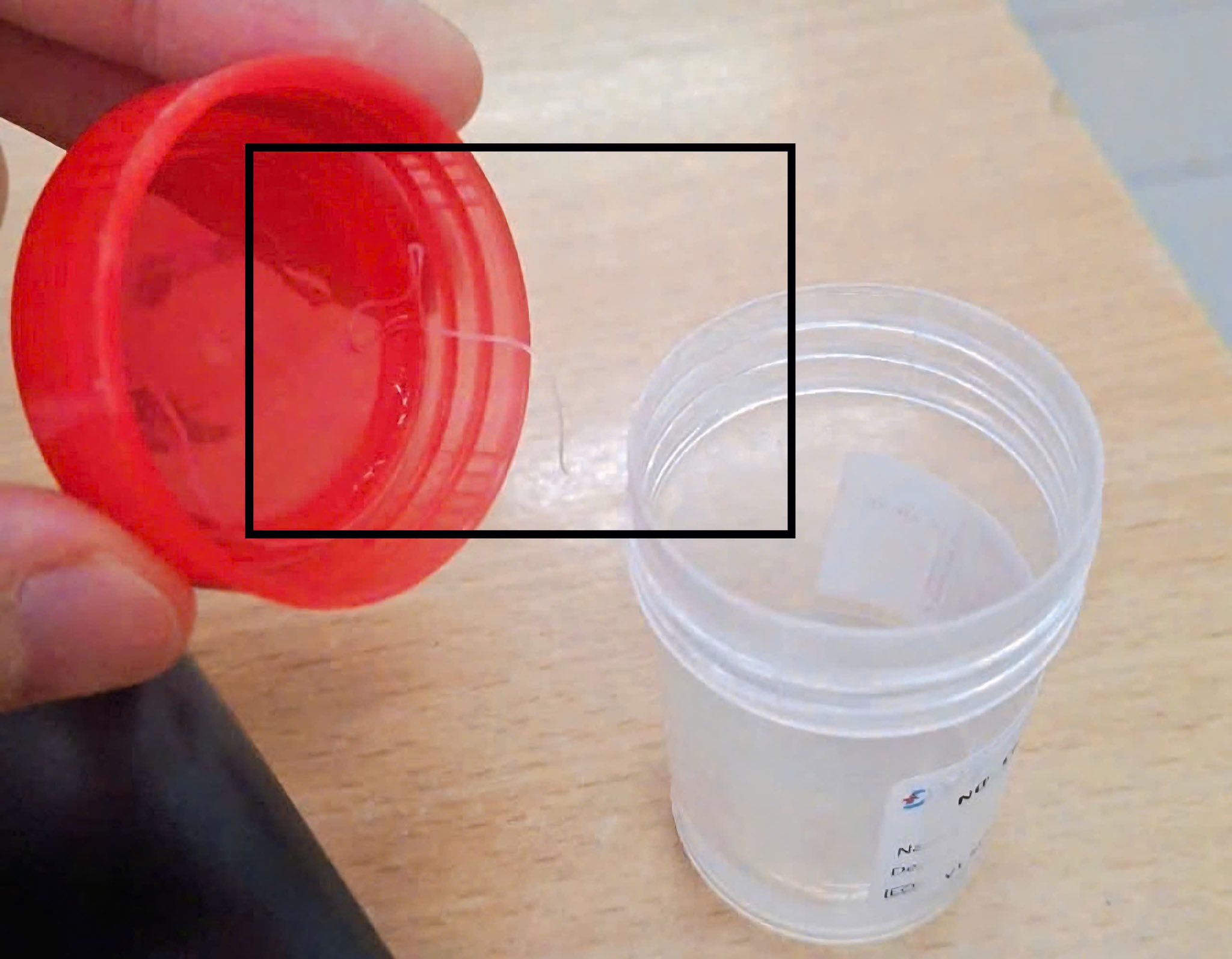 Hiếm gặp: Phát hiện ký sinh trùng dài gần 10cm trong mắt của bệnh nhân nữ- Ảnh 1.
