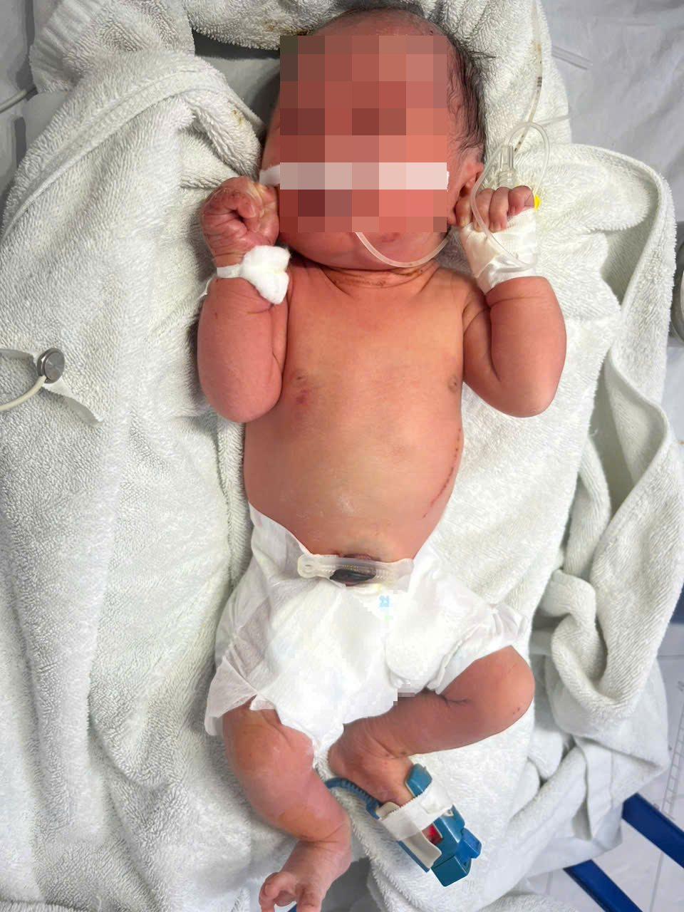 Hà Nội: Bé gái sơ sinh bị bỏ rơi ở bụi chuối, trên người nhiều vết xước và côn trùng đốt- Ảnh 1.
