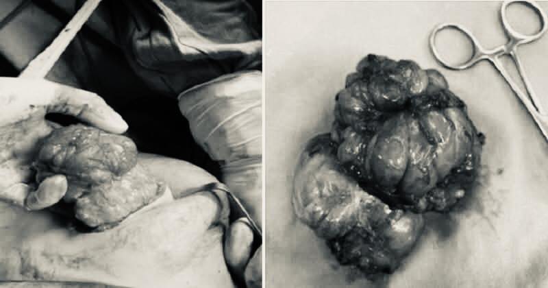 Thấy bất thường ở ngực, người phụ nữ 38 tuổi ở Hà Nội đi khám bất ngờ phát hiện khối u hiếm gặp- Ảnh 3.