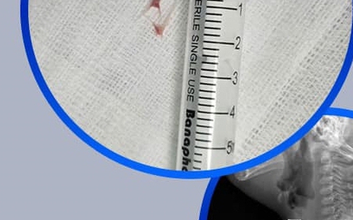 Người phụ nữ 58 tuổi nhập viện v&igrave; chủ quan với h&oacute;c xương c&aacute;, b&aacute;c sĩ chỉ r&otilde; sai lầm nhiều người mắc phải - Ảnh 2.