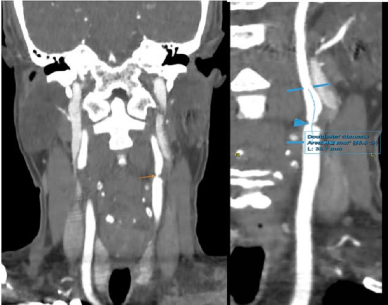 Người đàn ông 63 tuổi ở Hà Nội phát hiện bệnh lý tim mạch thừa nhận một sai lầm nhiều người Việt bỏ qua - Ảnh 2.
