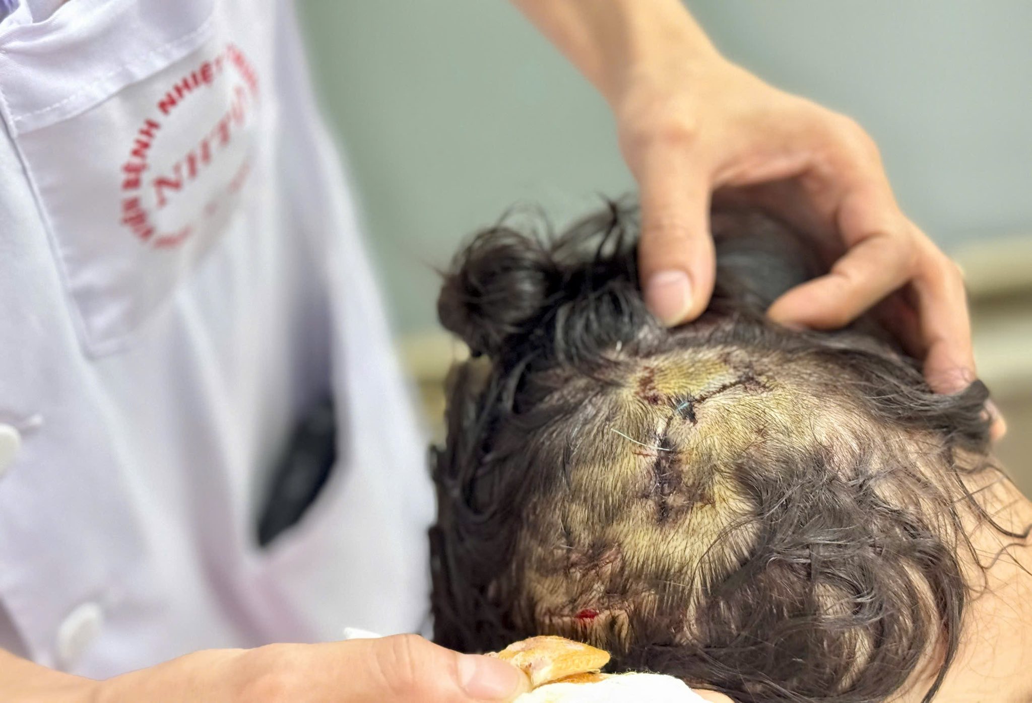 Thương tâm bé gái 5 tuổi bị chó nhà cắn nham nhở vùng đầu - Ảnh 1.