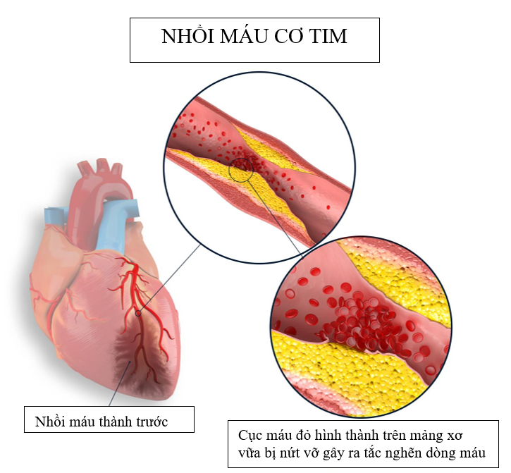 Cách phòng ngừa bệnh nhồi máu cơ tim cấp hiệu quả, người Việt tuyệt đối không bỏ qua - Ảnh 3.
