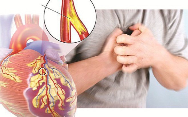 Người đàn ông ở Vĩnh Phúc 2 lần ngừng tim do nhồi máu cơ tim cấp từ dấu hiệu nhiều người Việt bỏ qua- Ảnh 3.