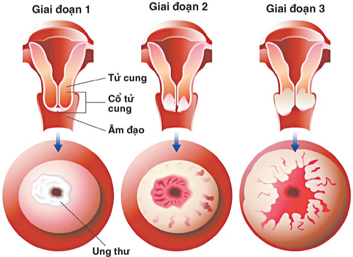 Chị em cần biết điều này trước khi làm tầm soát ung thư cổ tử cung- Ảnh 3.