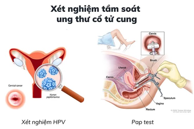Chị em cần biết điều này trước khi làm tầm soát ung thư cổ tử cung- Ảnh 2.