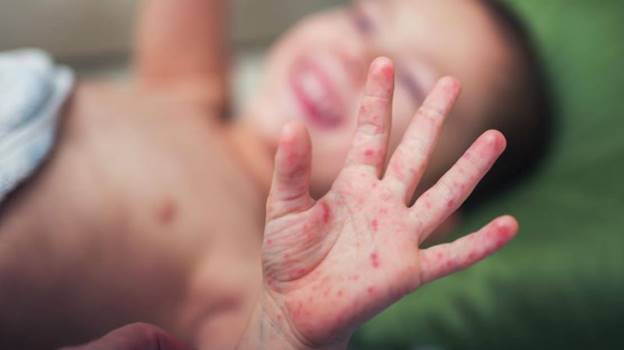 Những điều cha mẹ cần biết về bệnh tay chân miệng ở trẻ nhỏ- Ảnh 2. Những điều cha mẹ cần biết về bệnh tay chân miệng ở trẻ nhỏ- Ảnh 2.