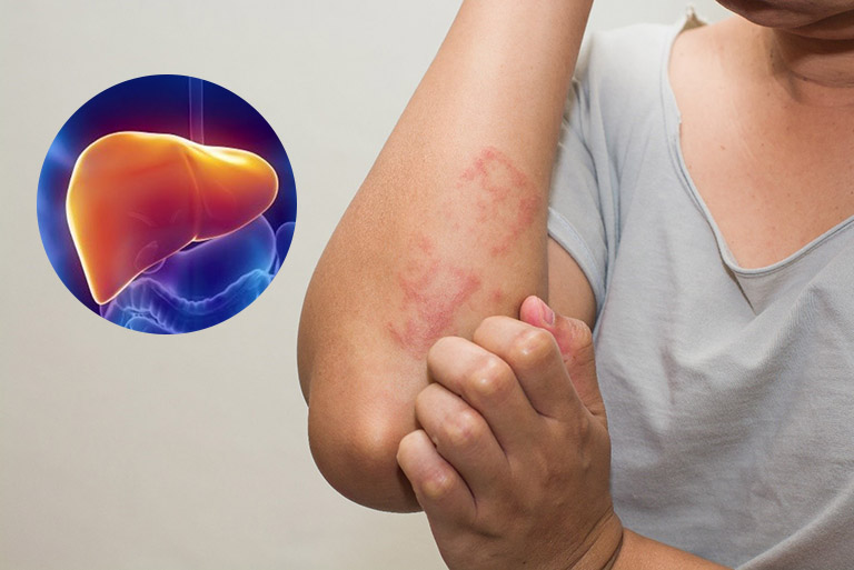 Khi nào nên thải độc gan, đây là 3 nhóm người cần cảnh giác - Ảnh 3.