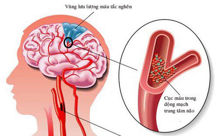 nhoi-mau-nao-dot-quy-1743739733907118915066-0-0-456-730-crop-1743739751351260294920.jpg