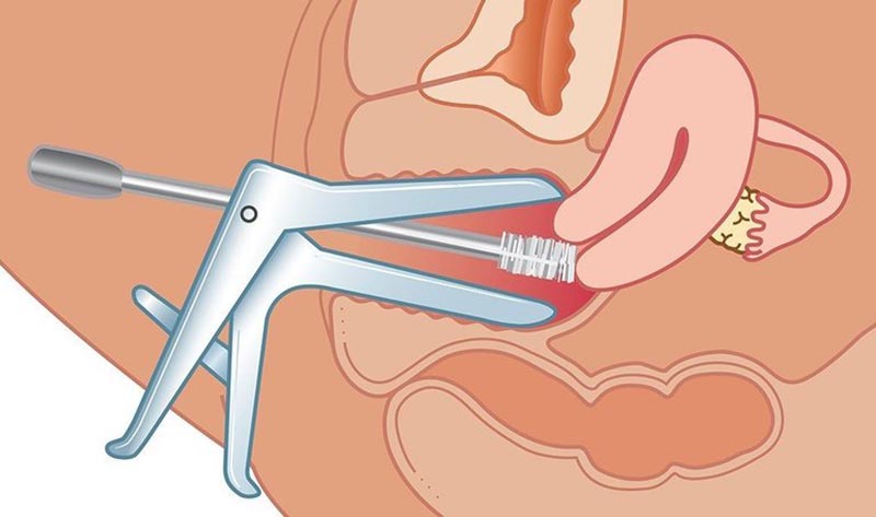 Người phụ nữ 35 tuổi đang khỏe mạnh bỗng phát hiện sớm ung thư cổ tử cung nhờ làm việc này- Ảnh 2. Người phụ nữ 35 tuổi đang khỏe mạnh bỗng phát hiện sớm ung thư cổ tử cung nhờ làm việc này- Ảnh 2.