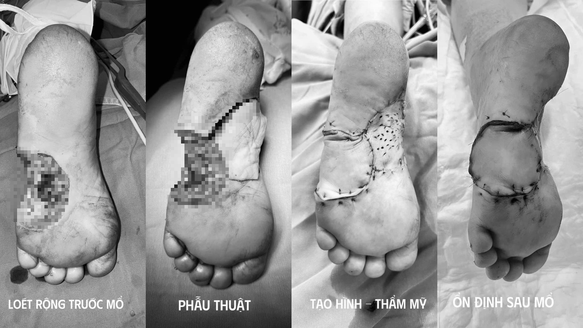 Người phụ nữ ở Hà Nội suýt phải cắt cụt chân chỉ vì một nốt ruồi nhỏ- Ảnh 1.