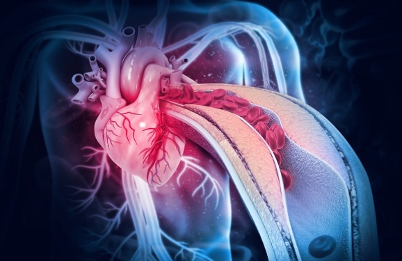Người đàn ông 40 tuổi phát hiện nhồi máu cơ tim dạng nguy hiểm nhất từ dấu hiệu nhiều người Việt bỏ qua - Ảnh 3. Người đàn ông 40 tuổi phát hiện nhồi máu cơ tim dạng nguy hiểm nhất từ dấu hiệu nhiều người Việt bỏ qua - Ảnh 3.