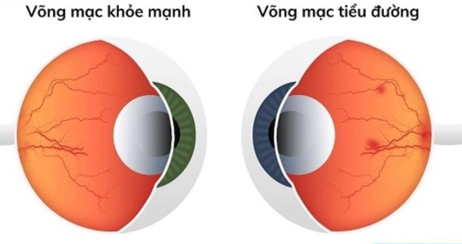 Người đàn ông 63 tuổi mắc bệnh tiểu đường suýt mù vĩnh viễn, thừa nhận 1 sai lầm nhiều người Việt mắc phải - Ảnh 2.